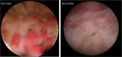 Eosinophilic cystitis refractory to steroids successfully treated with benralizumab: A case report